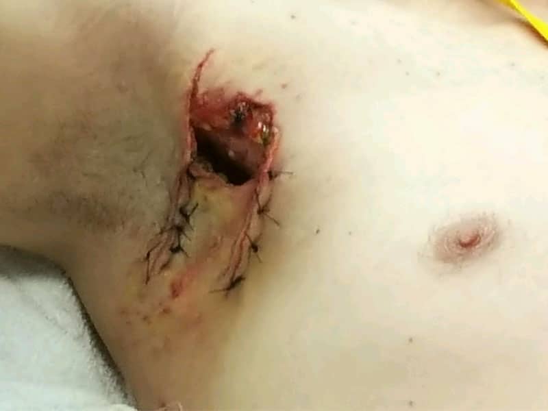James Cicco's chest after receiving treatment for bite wounds at the hospital / submitted photo